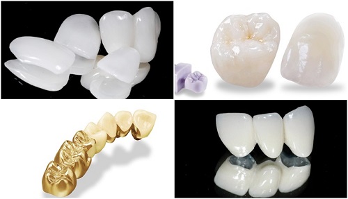 Các loại răng sứ phổ biến-1