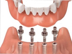 Cẩm nang cho quá trình trồng răng implant-3 Cẩm nang cho quá trình trồng răng implant-3