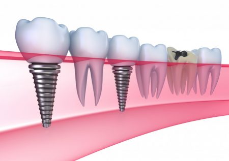 Cẩm nang cho quá trình trồng răng implant-2 Cẩm nang cho quá trình trồng răng implant-2
