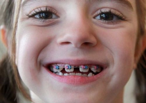 Điều trị chỉnh hình răng hàm mặt ở trẻ em-2