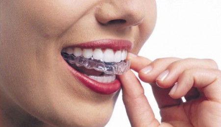 Các loại niềng răng nha khoa 1