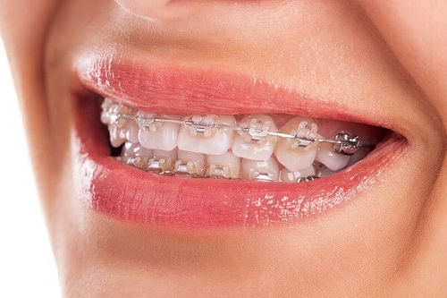 Phương pháp điều trị niềng răng thẩm mỹ-3