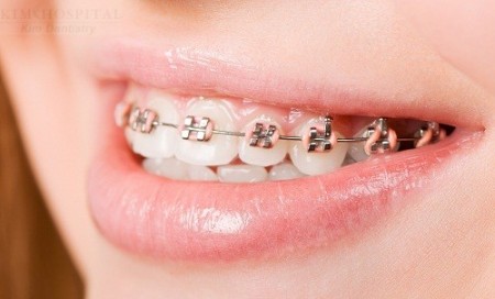 Phương pháp điều trị niềng răng thẩm mỹ