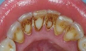 So sánh tẩy trắng răng tại nhà và tẩy trắng răng tại nha khoa-1
