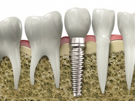 Trồng răng Implant hết thời gian bao lâu 