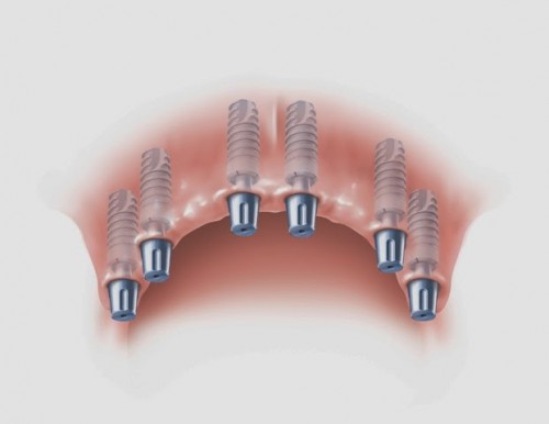 Cấy ghép răng implant ở nha khoa đăng lưu