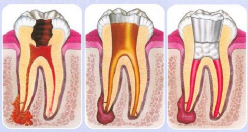 Điều trị viêm tủy răng có hiệu quả không?-3