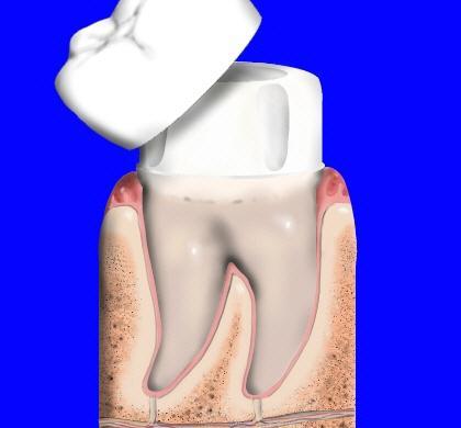 Bọc răng sứ cho răng hàm bị sâu 