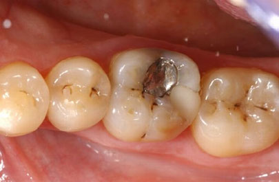 Bọc răng sứ cho răng hàm bị sâu 
