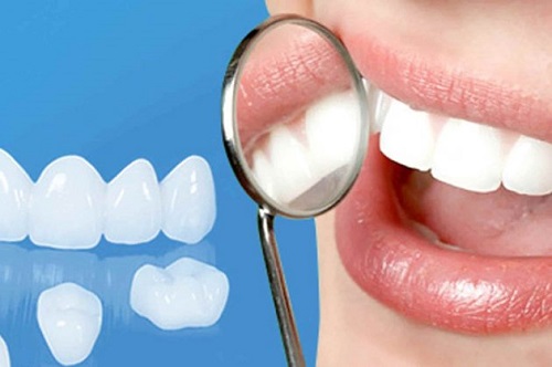 Răng sứ Veneer có ưu điểm là gì?-3