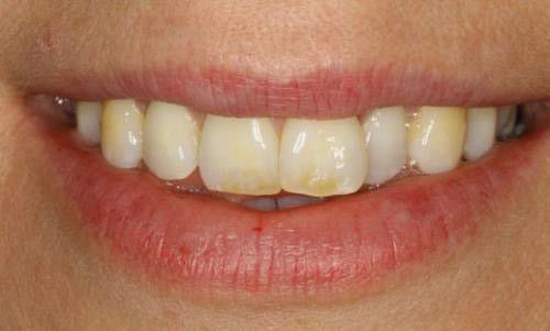 Nguyên nhân răng đổi màu và cách điều trị-1