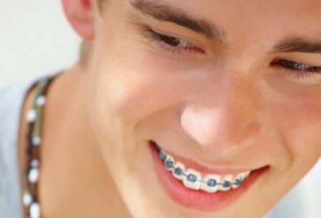 Giải pháp mới điều trị răng hô