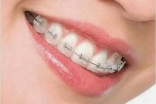 Niềng răng hay bọc răng sứ khi bị hô răng