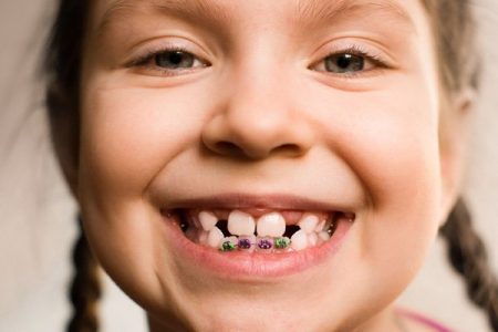 Chỉnh răng sớm cho trẻ em-2