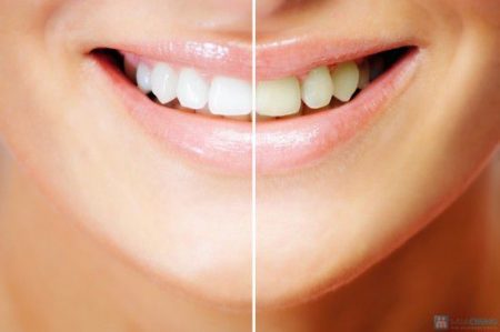Tẩy trắng răng hiệu quả an toàn-2