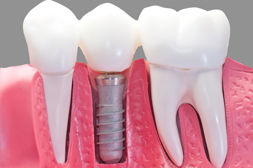 Lợi thế về chi phí khi cấy ghép implant