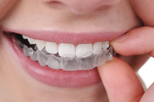 Quy trình niềng răng bằng khay Invisalign-1