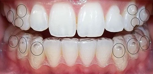 Tác dụng của hàm duy trì sau khi tháo niềng răng-2