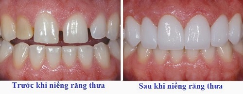 Niềng răng mắc cài sứ Damon Clear là gì?-2