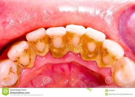 Lấy vôi răng có làm mòn răng không 