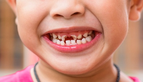 Hiện tượng sâu răng sữa ở trẻ