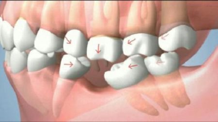 Cấy ghép răng implant ở đâu tốt an toàn uy tín nhất?-1