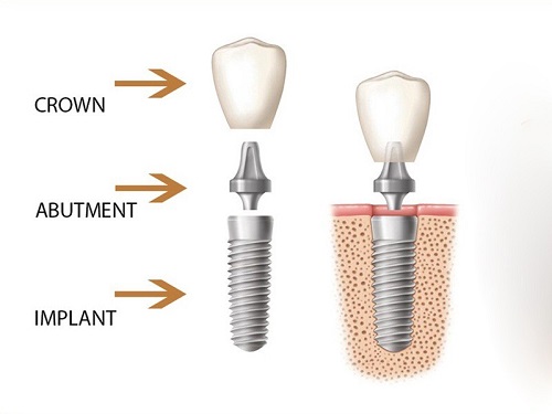 Cấy ghép răng Implant giá bao nhiêu tiền? 1