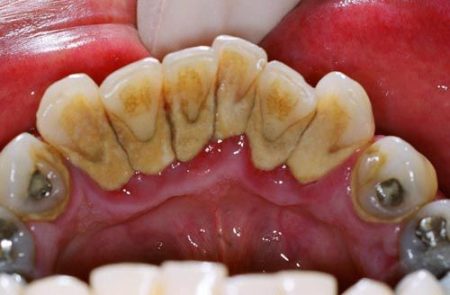 Cạo vôi răng có lợi hay hại? 1