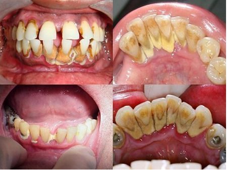 Cạo vôi răng có lợi hay hại? 2
