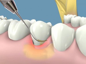 Cạo vôi răng có lợi hay hại? 3