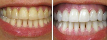 Nên tẩy trắng răng bằng phương pháp nào? 6