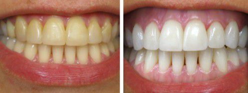 Răng vàng có tẩy trắng được không? 1