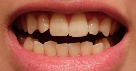 Răng vàng có tẩy trắng được không? 3