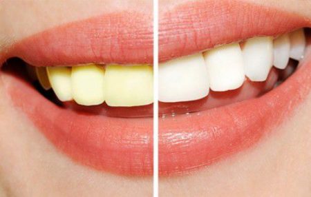 Răng vàng có tẩy trắng được không? 6