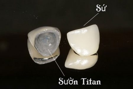 Răng sứ titan giá bao nhiêu tiền là chuẩn?