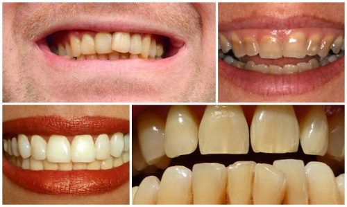 Phương pháp tẩy trắng răng bằng laser whitening như thế nào? 1