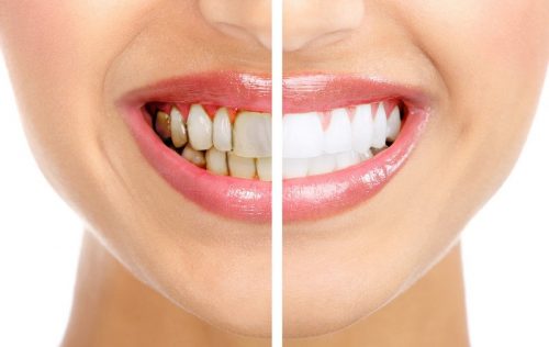 Phương pháp tẩy trắng răng bằng laser whitening như thế nào? 3