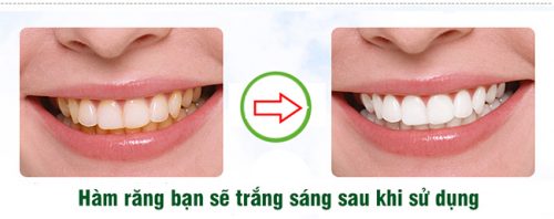 5 lý do bạn nên tìm hiểu sau tẩy trắng răng kiêng ăn gì 2 5 lý do bạn nên tìm hiểu sau tẩy trắng răng kiêng ăn gì 2