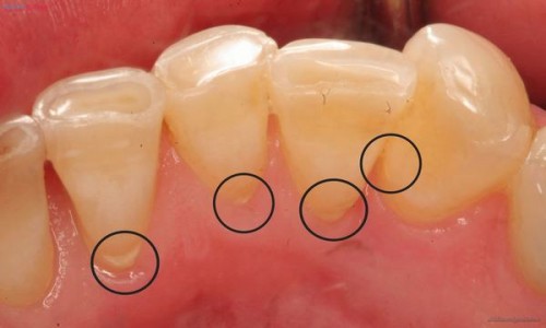 Tẩy trắng răng mất bao lâu thời gian thì có kết quả? 1