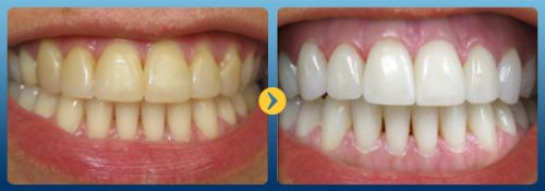 Tẩy trắng răng mất bao lâu thời gian thì có kết quả? 3