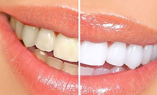 Tẩy trắng răng vĩnh viễn được không? 1