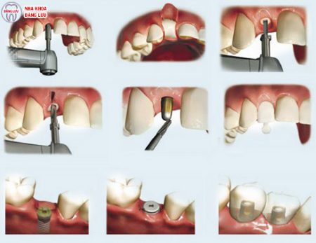 Làm thế nào để biết một địa chỉ trồng răng implant tốt? 2
