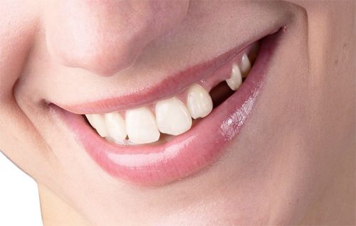 Phương pháp trồng răng sứ thẩm mỹ hiện nay 1