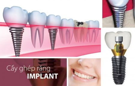 Quy trình cắm implant răng cửa như thế nào? 1