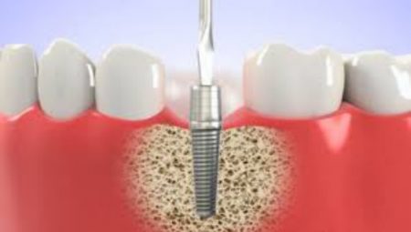 Quy trình cắm implant răng cửa như thế nào? 2