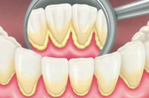 Cạo vôi răng có tác dụng gì? 1