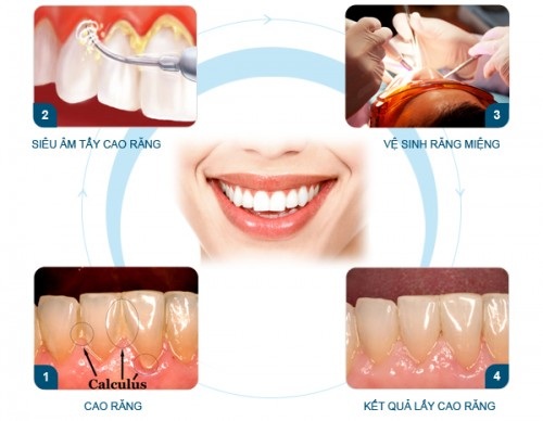 Cạo vôi răng có tác dụng gì? 2