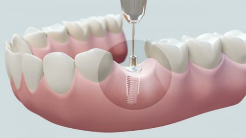 Cấy ghép răng implant là gì? 1 Cấy ghép răng implant là gì? 1