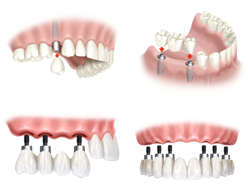 Cấy ghép răng implant là gì? 2 Cấy ghép răng implant là gì? 2