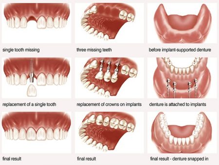 Quá trình cấy ghép implant cho răng hàm như thế nào? 1